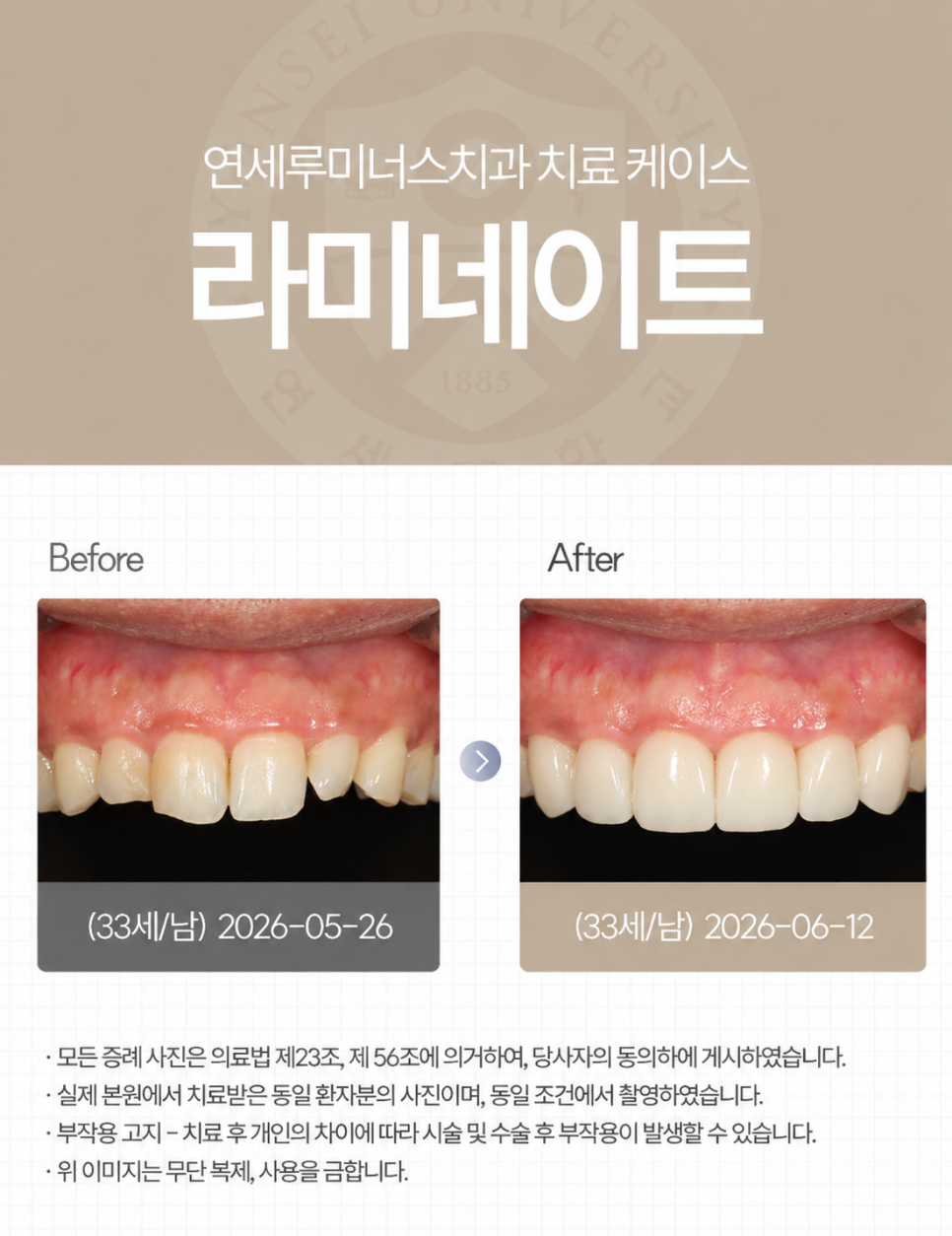 작고 불규칙했던 치아, 라미네이트로 자연스럽게 변화! 관련 이미지 1