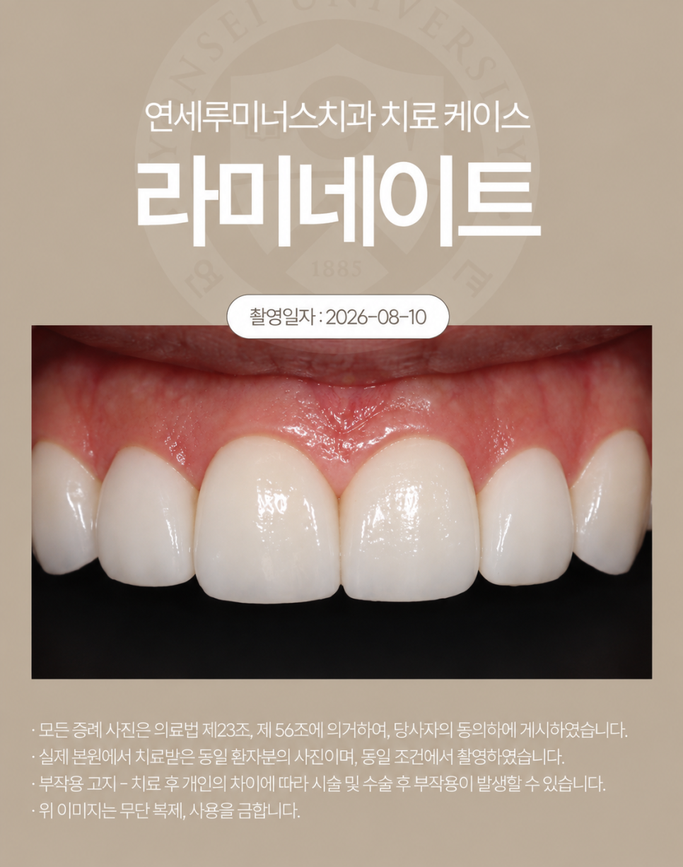 사진을 찍을 때 신경 쓰였던 치아, 라미네이트로 자연스럽게 변화 관련 이미지 3