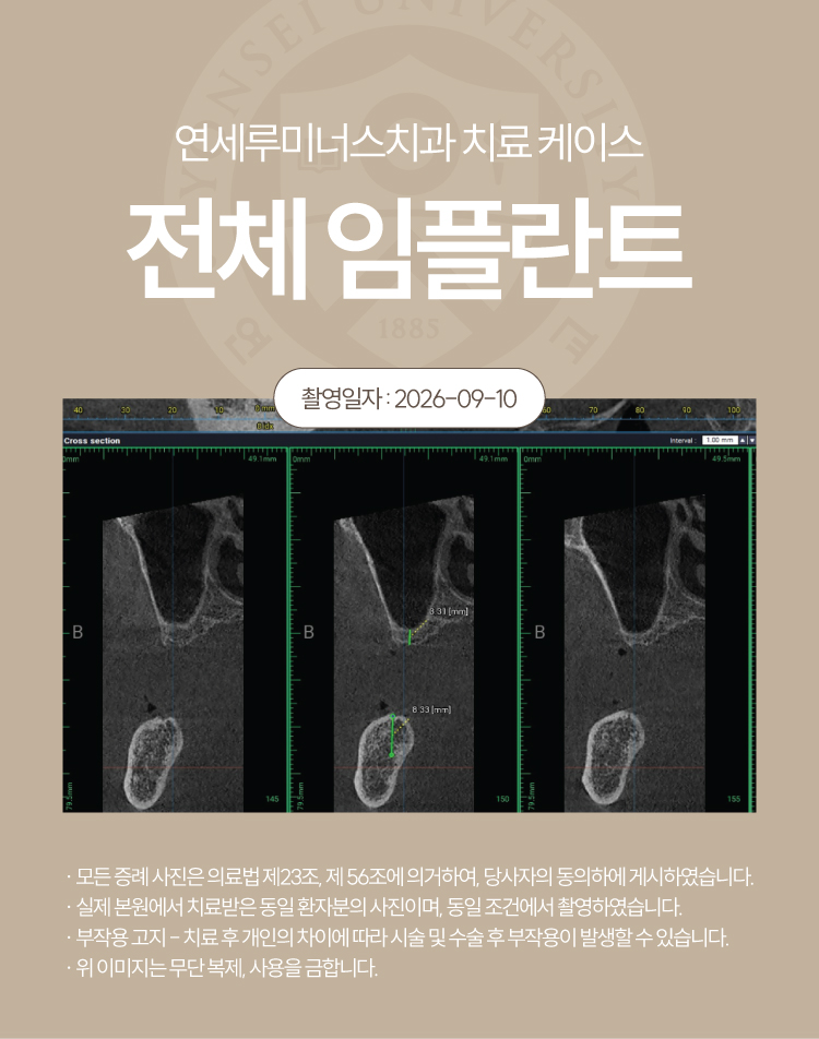 강남전체임플란트 케이스 : 제주도에서 찾아오신 무치악 환자, 당일 식립 완료 관련 이미지 5