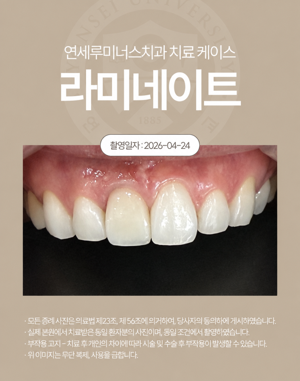 강남라미네이트 치료사례 - 색상, 라인개선 (30세/여) 관련 이미지 3