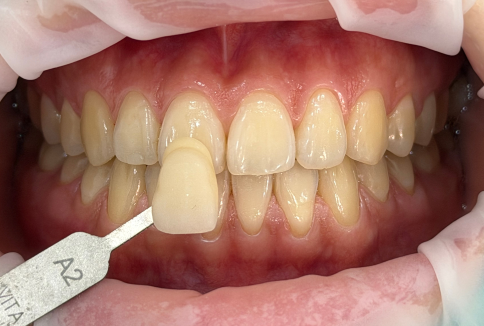 A Patient Came in for Whitening Again Today~~ image 1