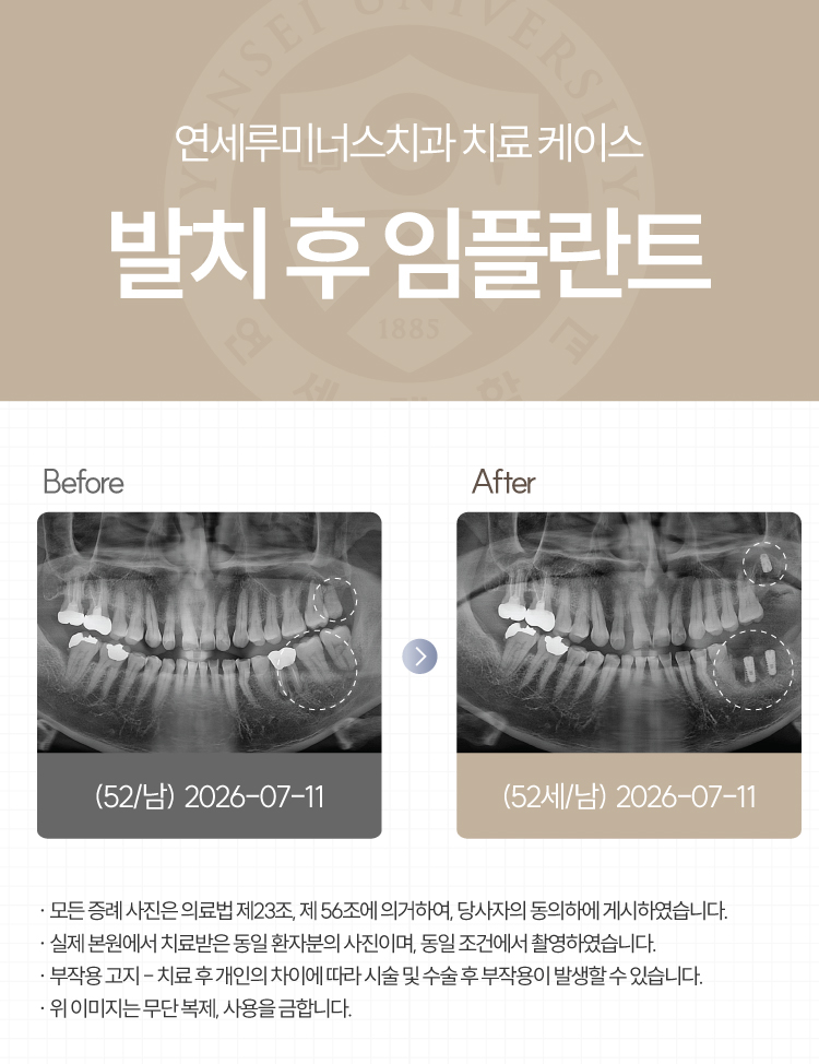 강남발치후임플란트 사례 ― 좌측 상하악 다발성 발치 및 즉시 임플란트 식립 (52세/남환자) 관련 이미지 1