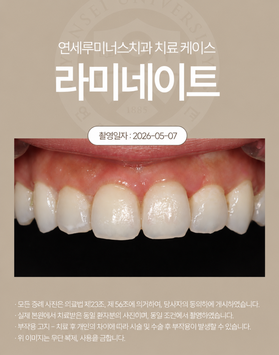 최소한의 치아 삭제로 완성한 자연스러운 강남라미네이트! 관련 이미지 2
