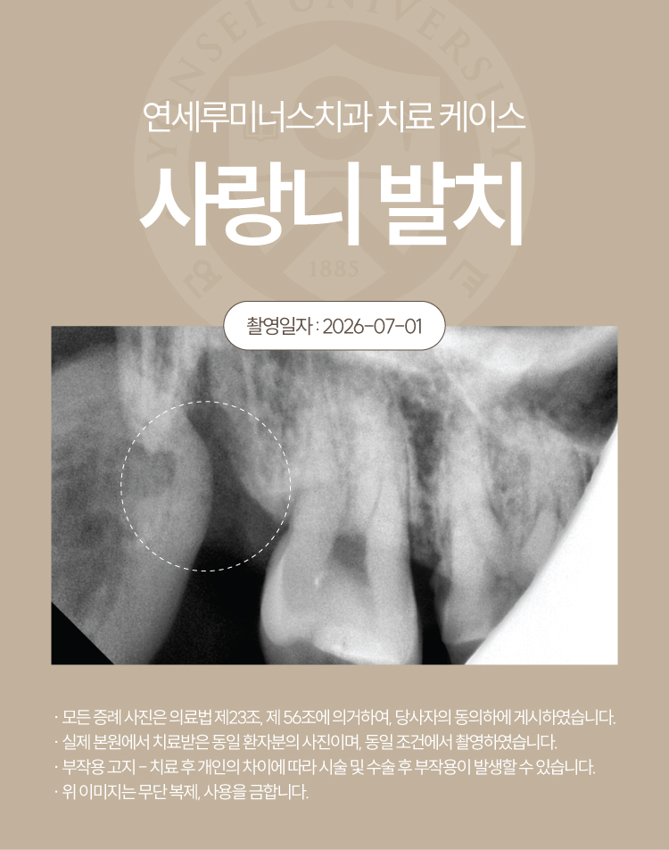 Gangnam Station Wisdom Tooth Extraction Case ― Simultaneous Extraction of Three Wisdom Teeth (21-Year-Old Female Patient) image 4
