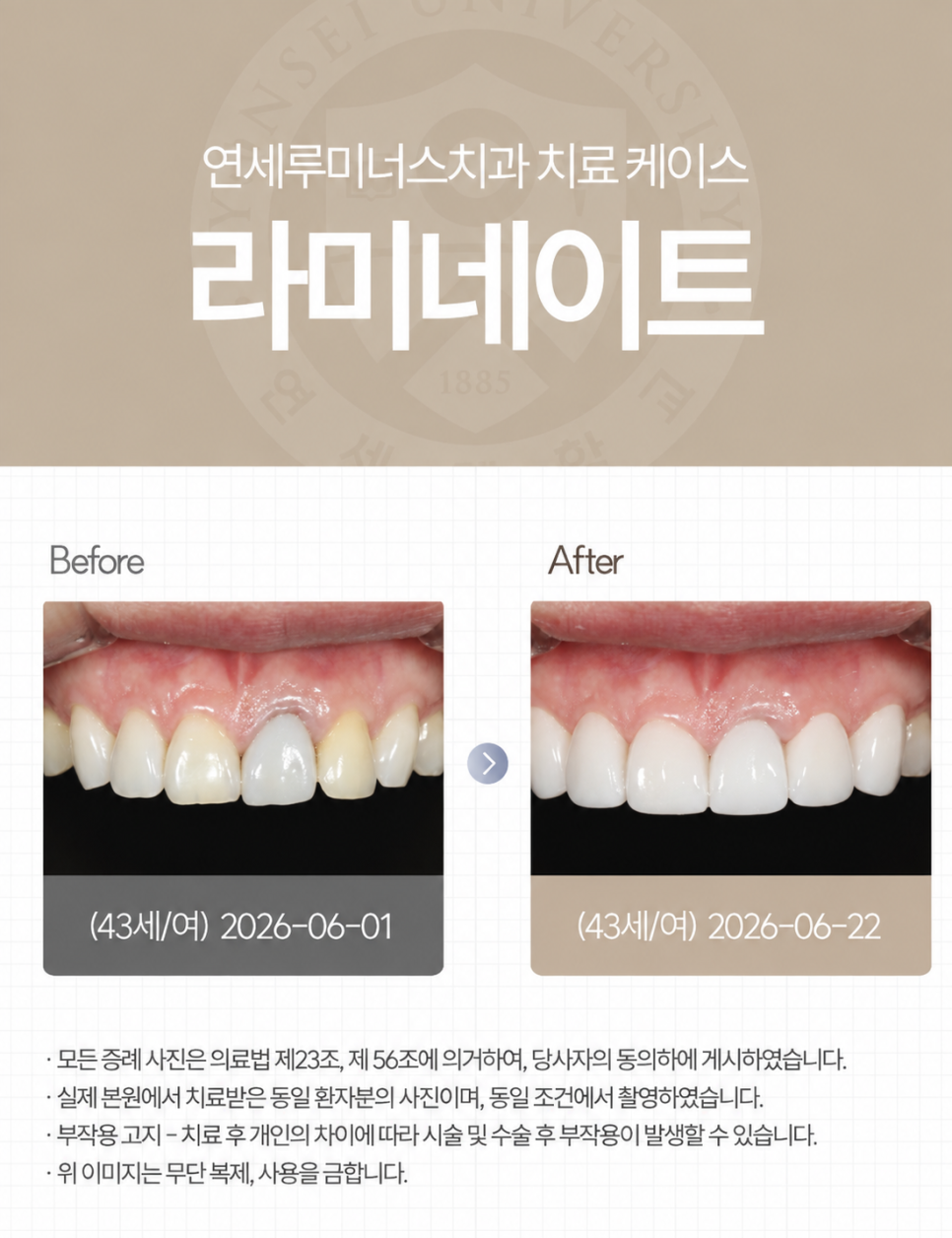 강남라미네이트 / 상악 라미네이트에 이어 하악까지! 완벽 보완 관련 이미지 1