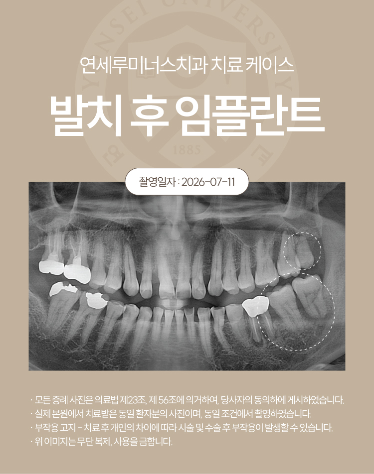 강남발치후임플란트 사례 ― 좌측 상하악 다발성 발치 및 즉시 임플란트 식립 (52세/남환자) 관련 이미지 2