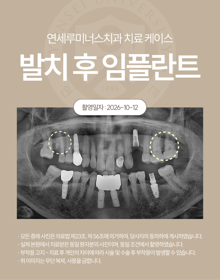 강남역임플란트 케이스 : 치관부 파절 및 치주 염증으로 발치 후 식립한 60대 여성 증례 관련 이미지 2