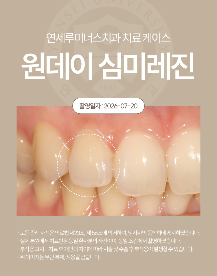 강남심미레진 치료사례 ― #12 앞니 심미레진 원데이 케이스 (30세/여환자) 관련 이미지 5