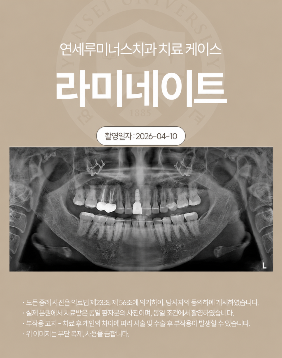 강남라미네이트 치료사례 - 색상, 라인개선 (30세/여) 관련 이미지 2