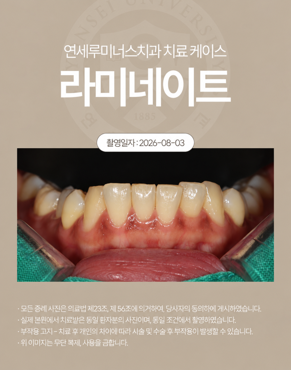 강남라미네이트 / 치아의 손상은 줄이고, 자연스러움은 더하는 방법 관련 이미지 4