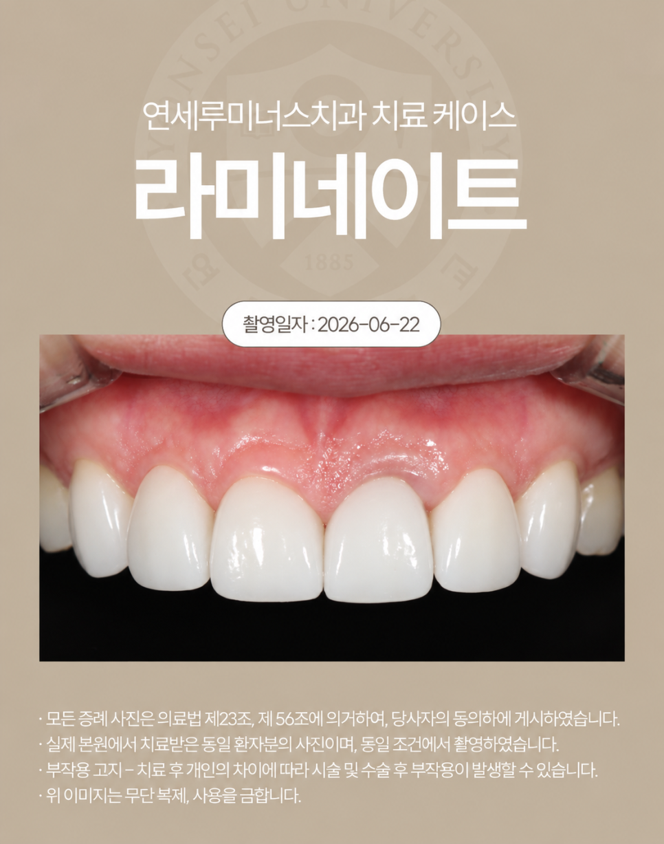 강남라미네이트 / 상악 라미네이트에 이어 하악까지! 완벽 보완 관련 이미지 3