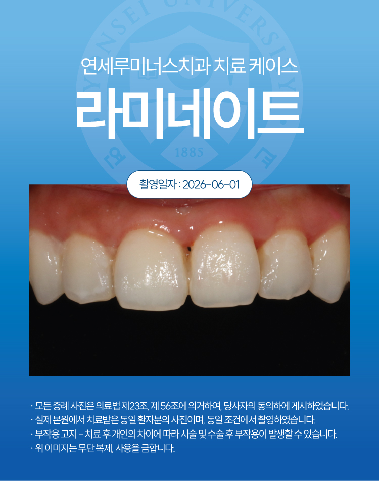 강남라미네이트 수복증례 ― 치아 표면의 석회화 반점 관련 이미지 2