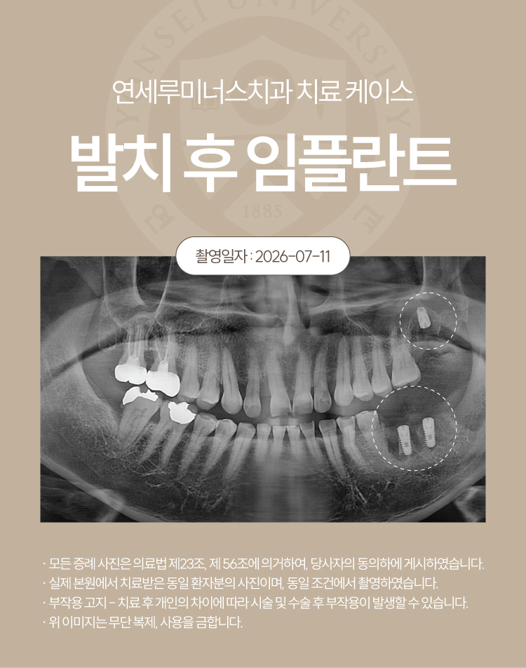 강남발치후임플란트 사례 ― 좌측 상하악 다발성 발치 및 즉시 임플란트 식립 (52세/남환자) 관련 이미지 9