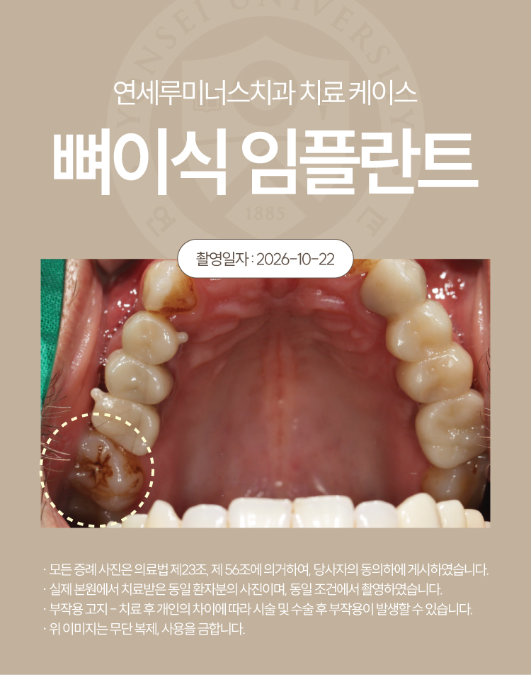 강남신경치료 케이스 : 사랑니까지 살린 17, 18번 치근단염 치료 (터키에서 오신 외국인 환자분!) 관련 이미지 2