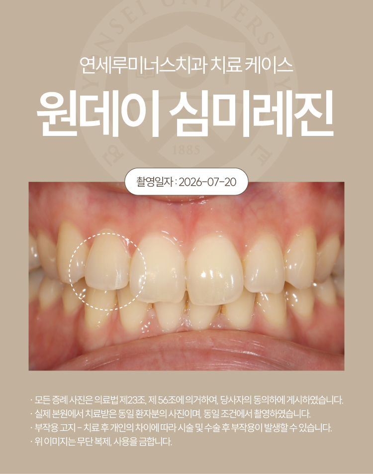 강남심미레진 치료사례 ― #12 앞니 심미레진 원데이 케이스 (30세/여환자) 관련 이미지 4