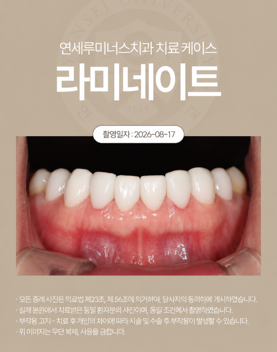 강남라미네이트 / 상악 라미네이트에 이어 하악까지! 완벽 보완 관련 이미지 6
