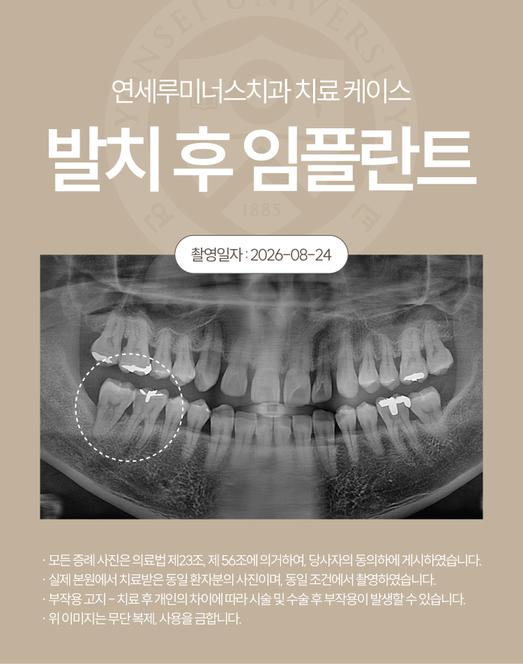강남발치후임플란트 케이스 - 심한 치주질환으로 인한 발치 후 즉시 임플란트 (40대/남환자) 관련 이미지 2