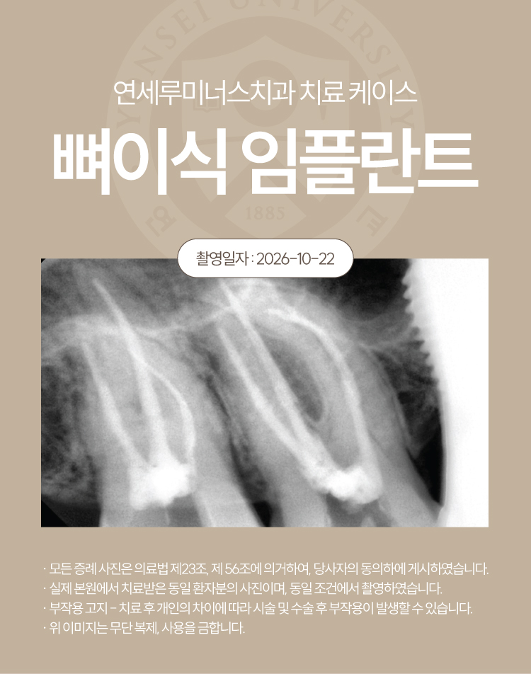 강남신경치료 케이스 : 사랑니까지 살린 17, 18번 치근단염 치료 (터키에서 오신 외국인 환자분!) 관련 이미지 7