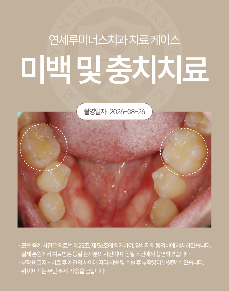 강남역치아미백 케이스 : 미백 중 발견한 충치까지 함께! (30대/여환자) 관련 이미지 3