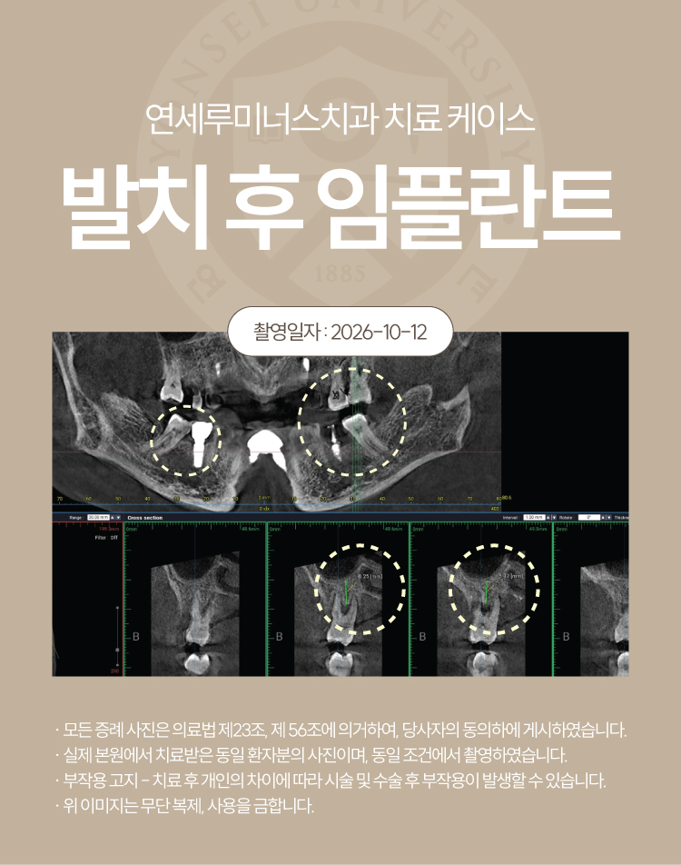 강남역임플란트 케이스 : 치관부 파절 및 치주 염증으로 발치 후 식립한 60대 여성 증례 관련 이미지 4