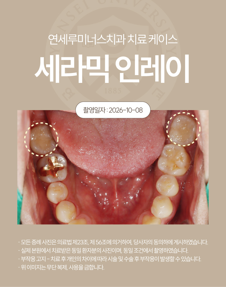 강남충치치료 케이스 : 직장동료 추천으로 내원한 20대 남성, 4개 세라믹 인레이 관련 이미지 3
