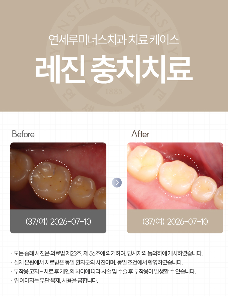 강남충치치료 사례 ― 충치 레진 충전 케이스 (37세/여환자/호주 외국인) 관련 이미지 1