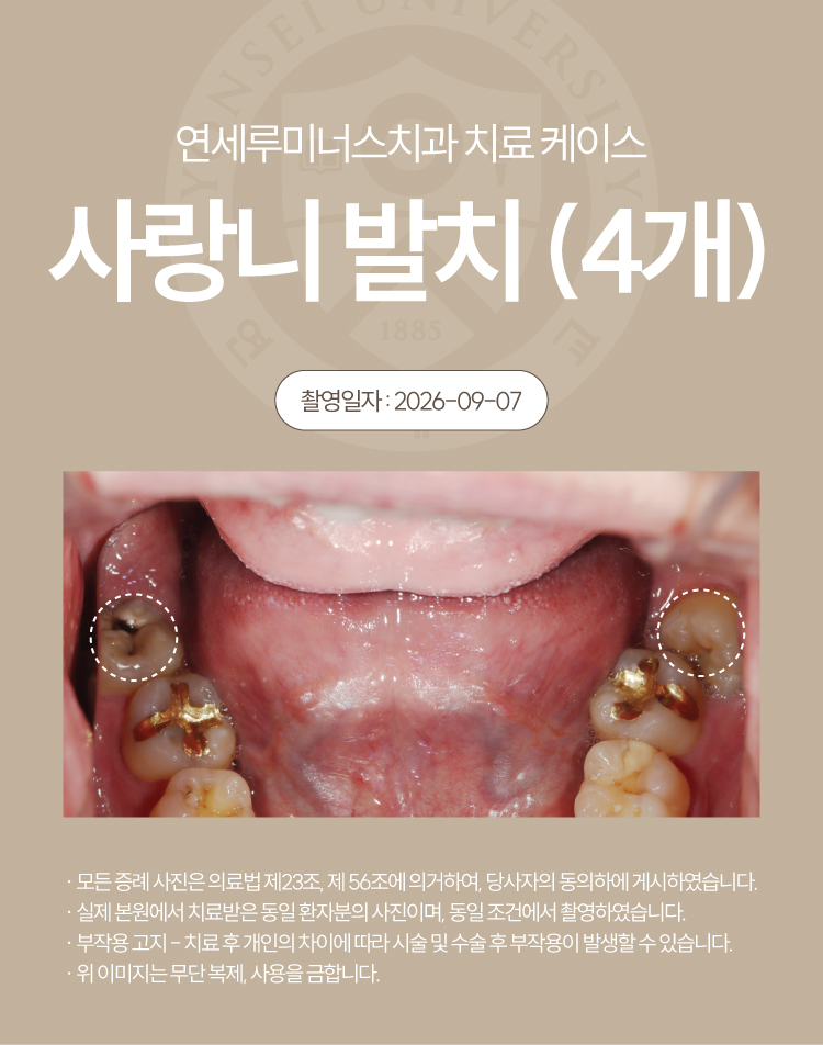 강남역사랑니발치, 4개 하루 만에 동시 발치 가능할까요? 관련 이미지 3