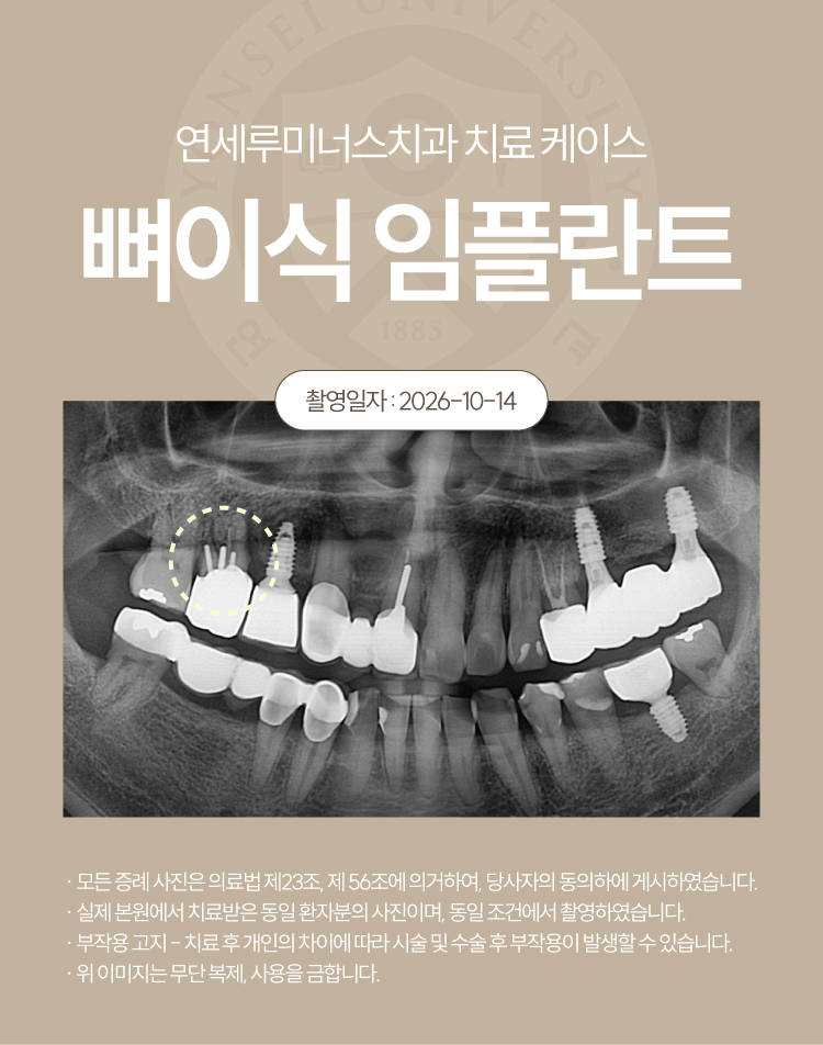 강남발치후임플란트 케이스 : 오른쪽 위 잇몸 붓기로 발견한 뿌리 염증, 발치 후 식립 관련 이미지 3