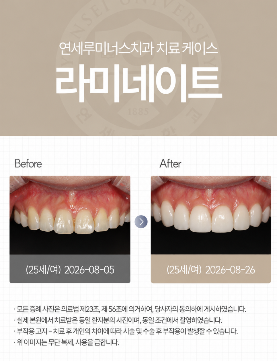 강남라미네이트 / 작고 어두운 치아, 자연스럽게 개선한 사례 관련 이미지 1