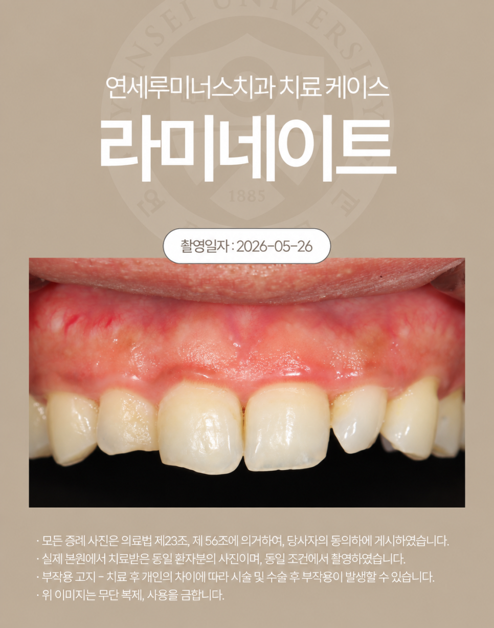 작고 불규칙했던 치아, 라미네이트로 자연스럽게 변화! 관련 이미지 2