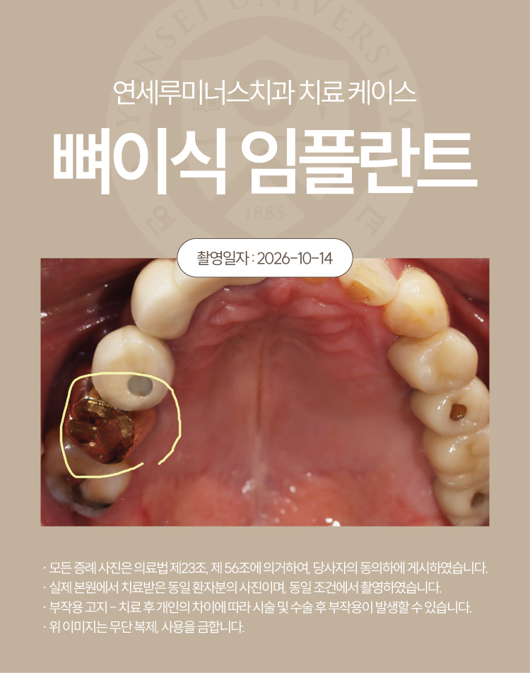 강남발치후임플란트 케이스 : 오른쪽 위 잇몸 붓기로 발견한 뿌리 염증, 발치 후 식립 관련 이미지 2
