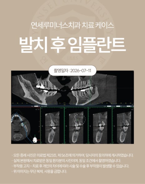 강남발치후임플란트 사례 ― 좌측 상하악 다발성 발치 및 즉시 임플란트 식립 (52세/남환자) 관련 이미지 5