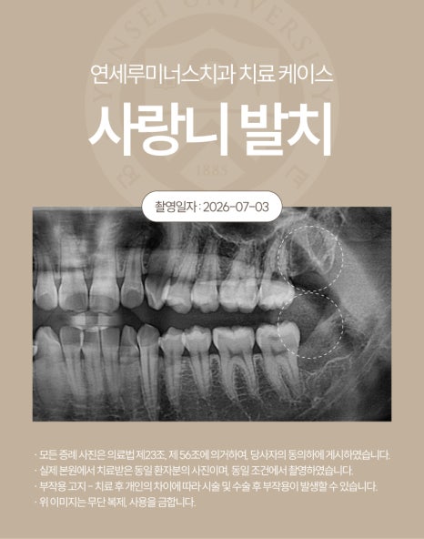 강남역사랑니발치 치료사례 ― 베트남 환자, 응급 내원 매복 사랑니 발치 케이스(10분 내 분할 발치 완료) 관련 이미지 5