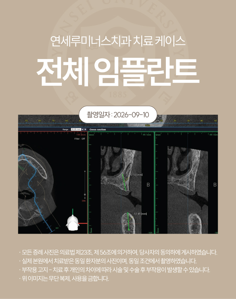 강남전체임플란트 케이스 : 제주도에서 찾아오신 무치악 환자, 당일 식립 완료 관련 이미지 3