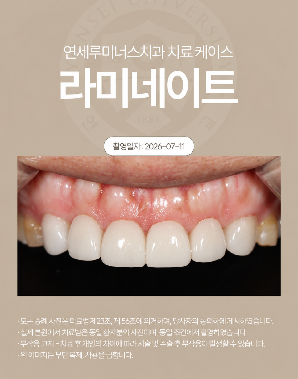 심하게 마모된 치아, 라미네이트로 회복할 수 있을까? 관련 이미지 3