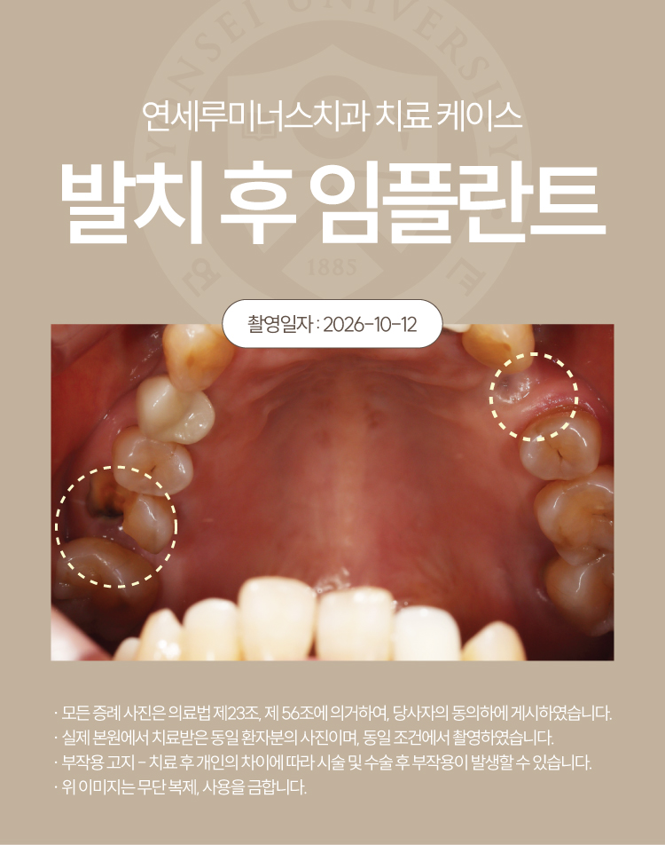 강남역임플란트 케이스 : 치관부 파절 및 치주 염증으로 발치 후 식립한 60대 여성 증례 관련 이미지 3