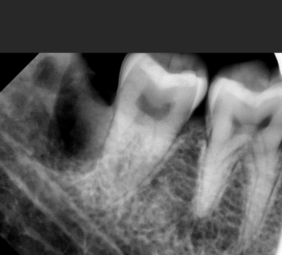 There Was a Wisdom Tooth.... Now It’s Gone!! image 3