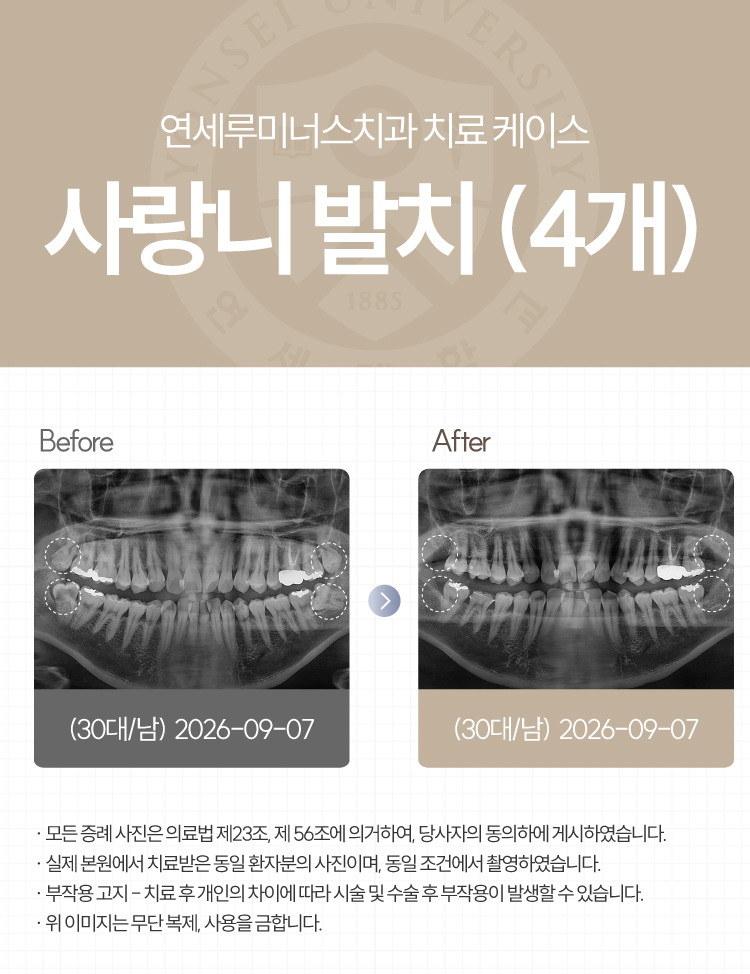 강남역사랑니발치, 4개 하루 만에 동시 발치 가능할까요? 관련 이미지 1