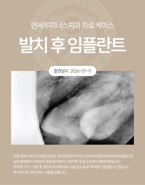 강남발치후임플란트 사례 ― 좌측 상하악 다발성 발치 및 즉시 임플란트 식립 (52세/남환자) 관련 이미지 4