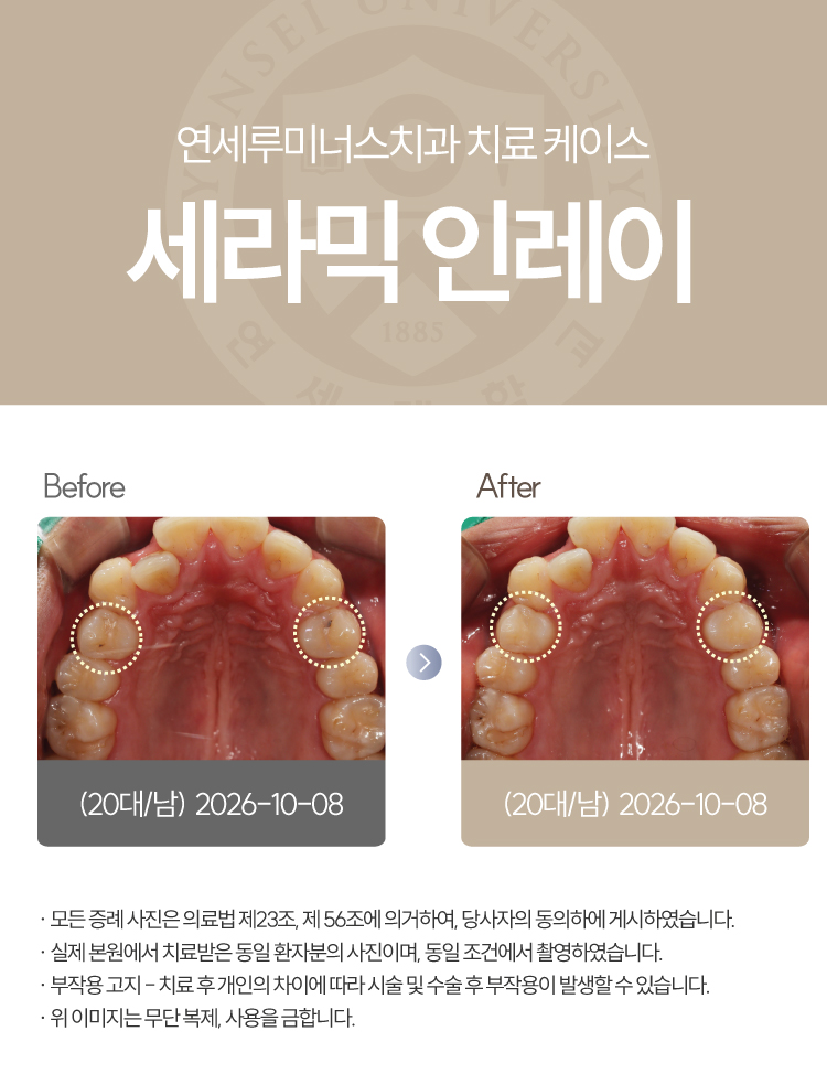 강남충치치료 케이스 : 직장동료 추천으로 내원한 20대 남성, 4개 세라믹 인레이 관련 이미지 6