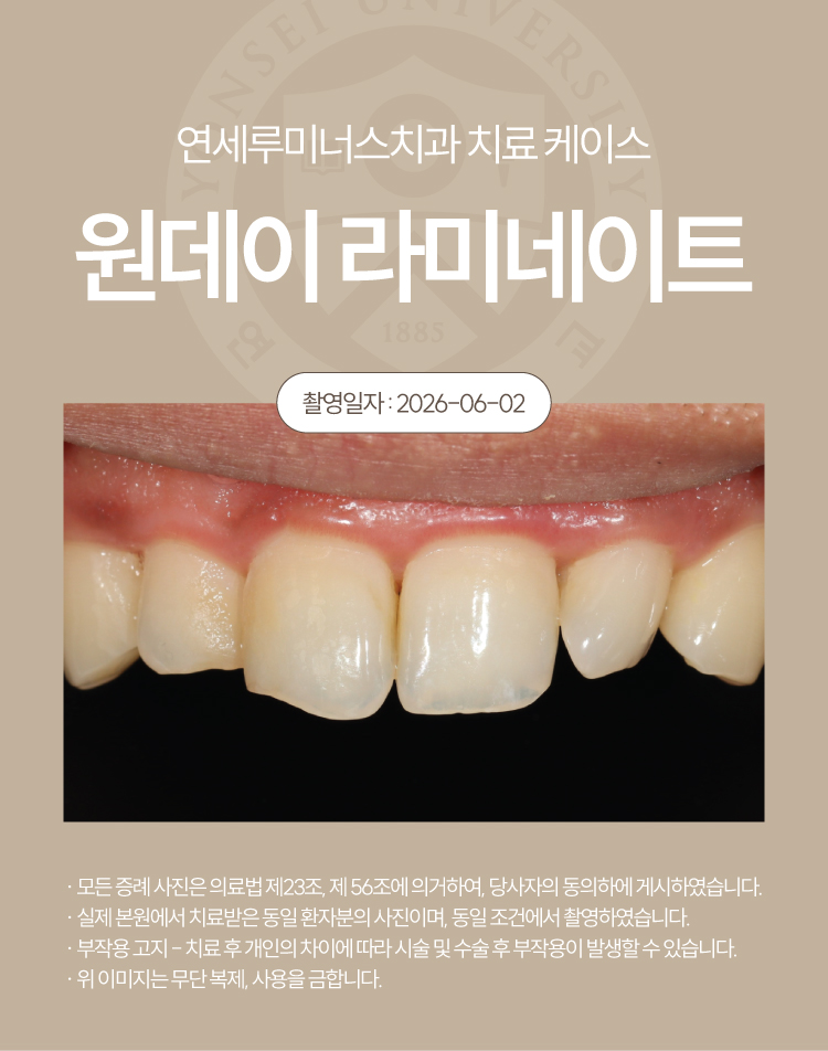 강남원데이라미네이트 치료사례 ― 색상, 라인 개선 (37세/남환자) 관련 이미지 2