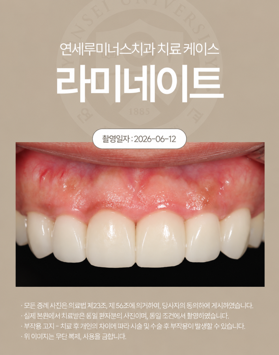 작고 불규칙했던 치아, 라미네이트로 자연스럽게 변화! 관련 이미지 3
