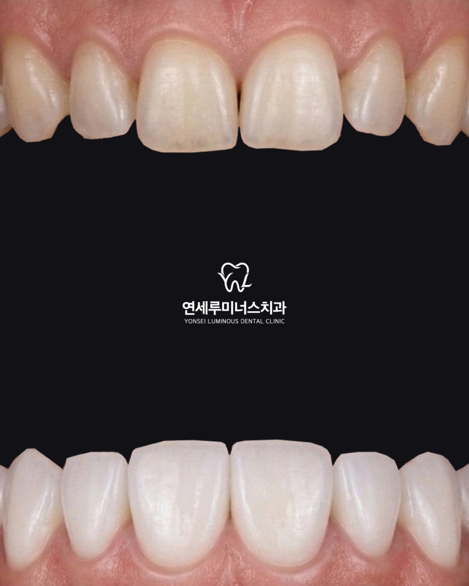 오늘은 제가 진료한 라미네이트 케이스를 공유해볼게요 관련 이미지 1