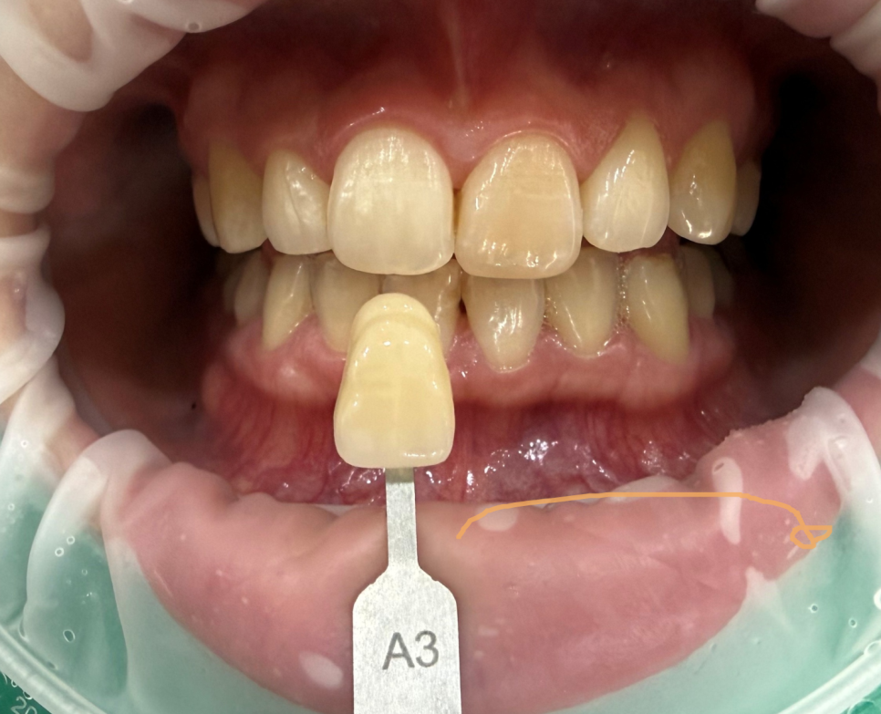 Teeth Whitening Again Today~~ image 1