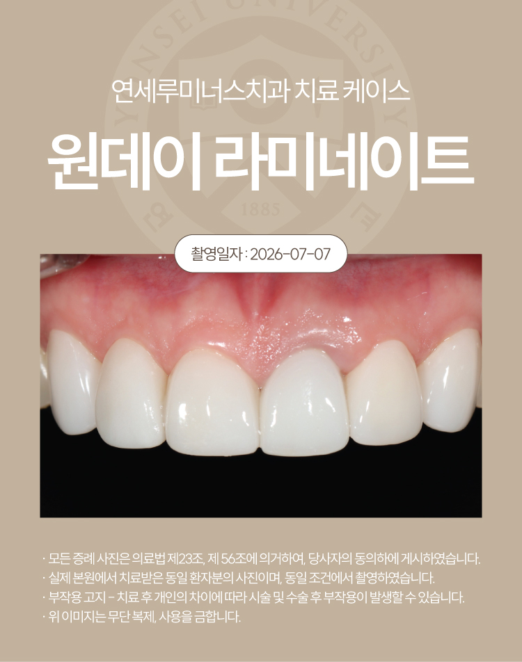 강남라미네이트 치료사례 ― 강원도 원주에서 찾아오신 라미네이트 + 2차충치 관련 이미지 4