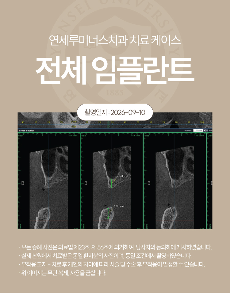 강남전체임플란트 케이스 : 제주도에서 찾아오신 무치악 환자, 당일 식립 완료 관련 이미지 4
