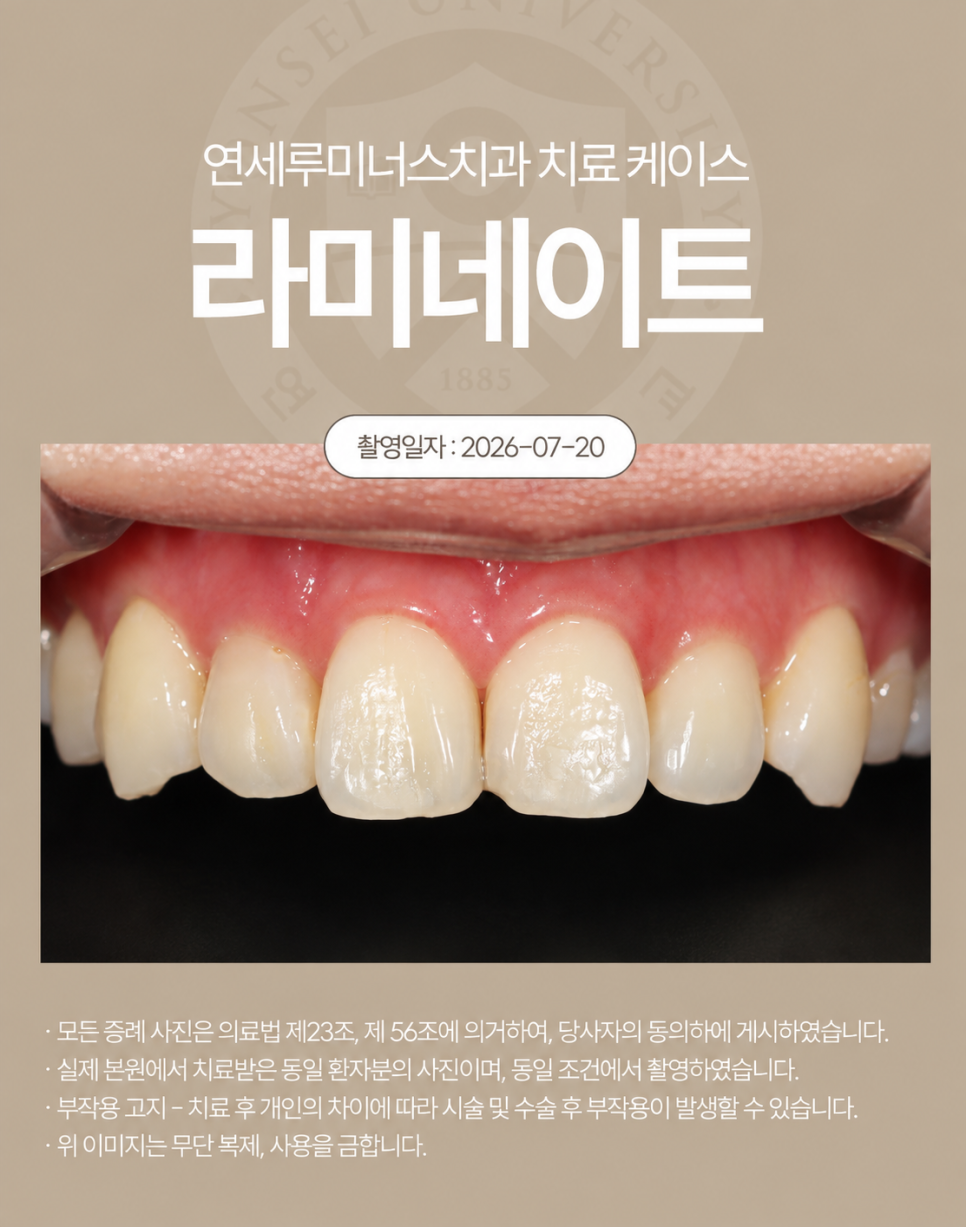 사진을 찍을 때 신경 쓰였던 치아, 라미네이트로 자연스럽게 변화 관련 이미지 2