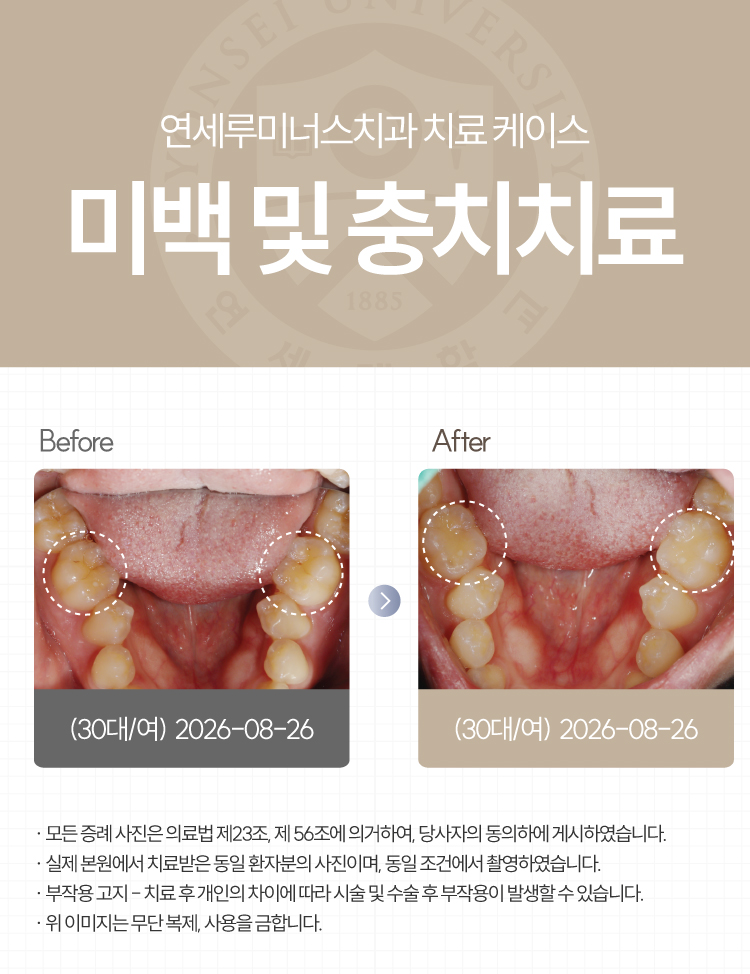 강남역치아미백 케이스 : 미백 중 발견한 충치까지 함께! (30대/여환자) 관련 이미지 1