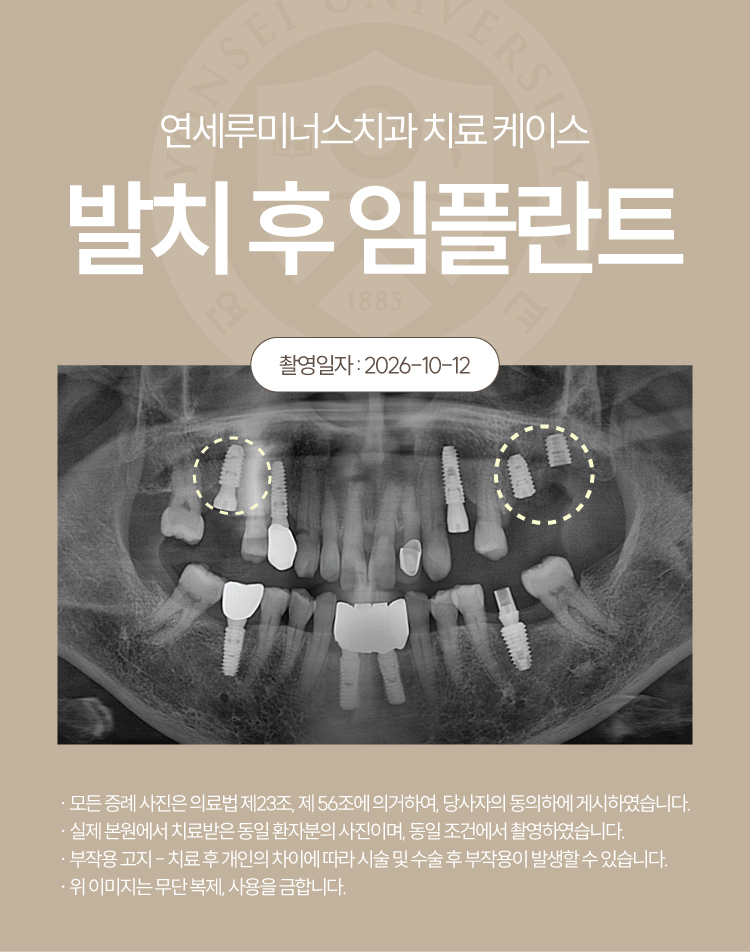 강남역임플란트 케이스 : 치관부 파절 및 치주 염증으로 발치 후 식립한 60대 여성 증례 관련 이미지 5