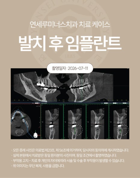 강남발치후임플란트 사례 ― 좌측 상하악 다발성 발치 및 즉시 임플란트 식립 (52세/남환자) 관련 이미지 8
